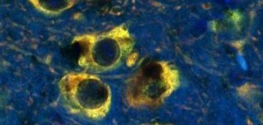 Thneuronas parkinsonjpg