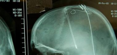 cerebro estimulacion