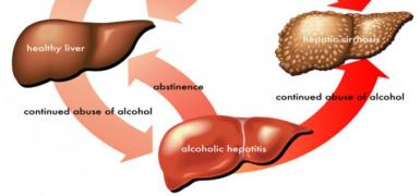 hepat cirrosis higado