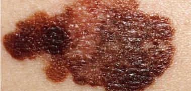 melanoma