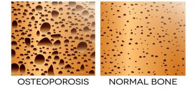 osteroporosis