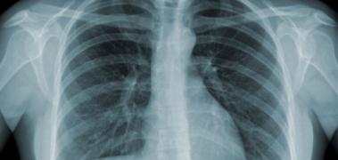 pulmones radiografia