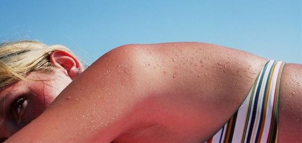 Dermatóloga advierte de los riesgos de exponerse al sol en exceso: `Tomar el sol puede ser tan perjudicial como fumar´