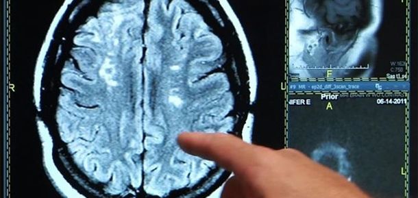 Un estudio muestra que la estimulación cerebral profunda es prometedora para los pacientes con ictus
